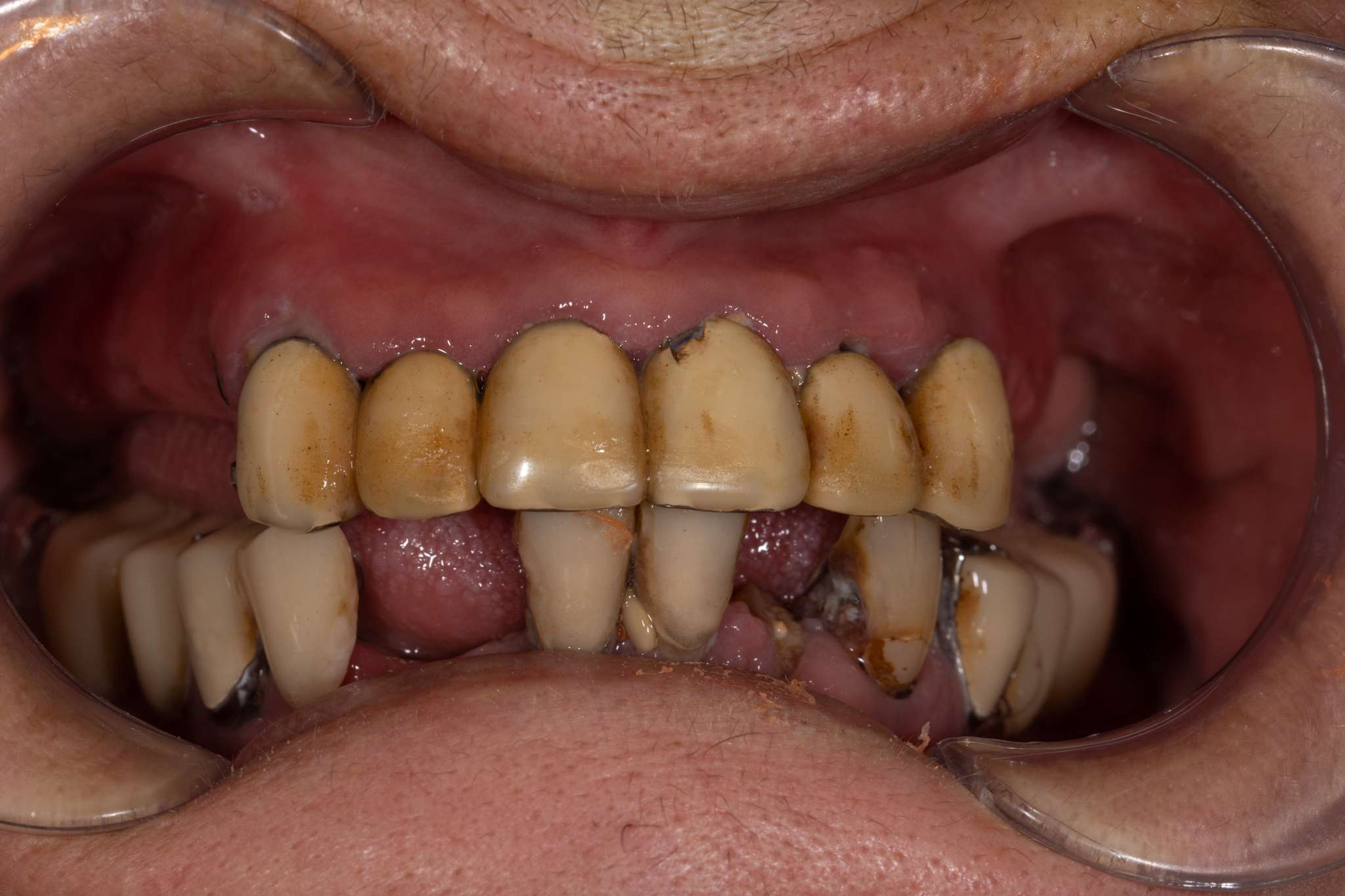 Caz All-on-X — stare inițială